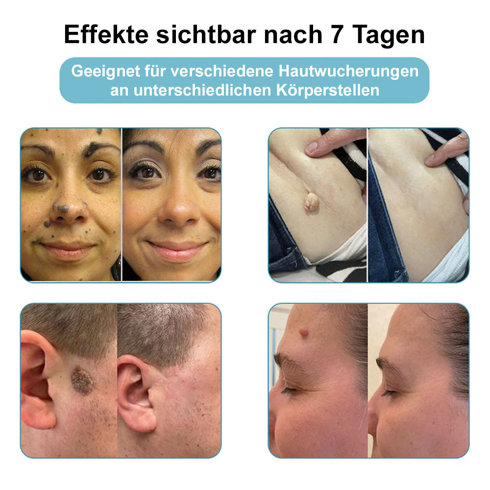 💙Bikenda® Nicht-invasiver Laser-Stift für Muttermale und Warzen – Schmerzfrei, narbenfrei, sicher | Dermatologisch geprüft