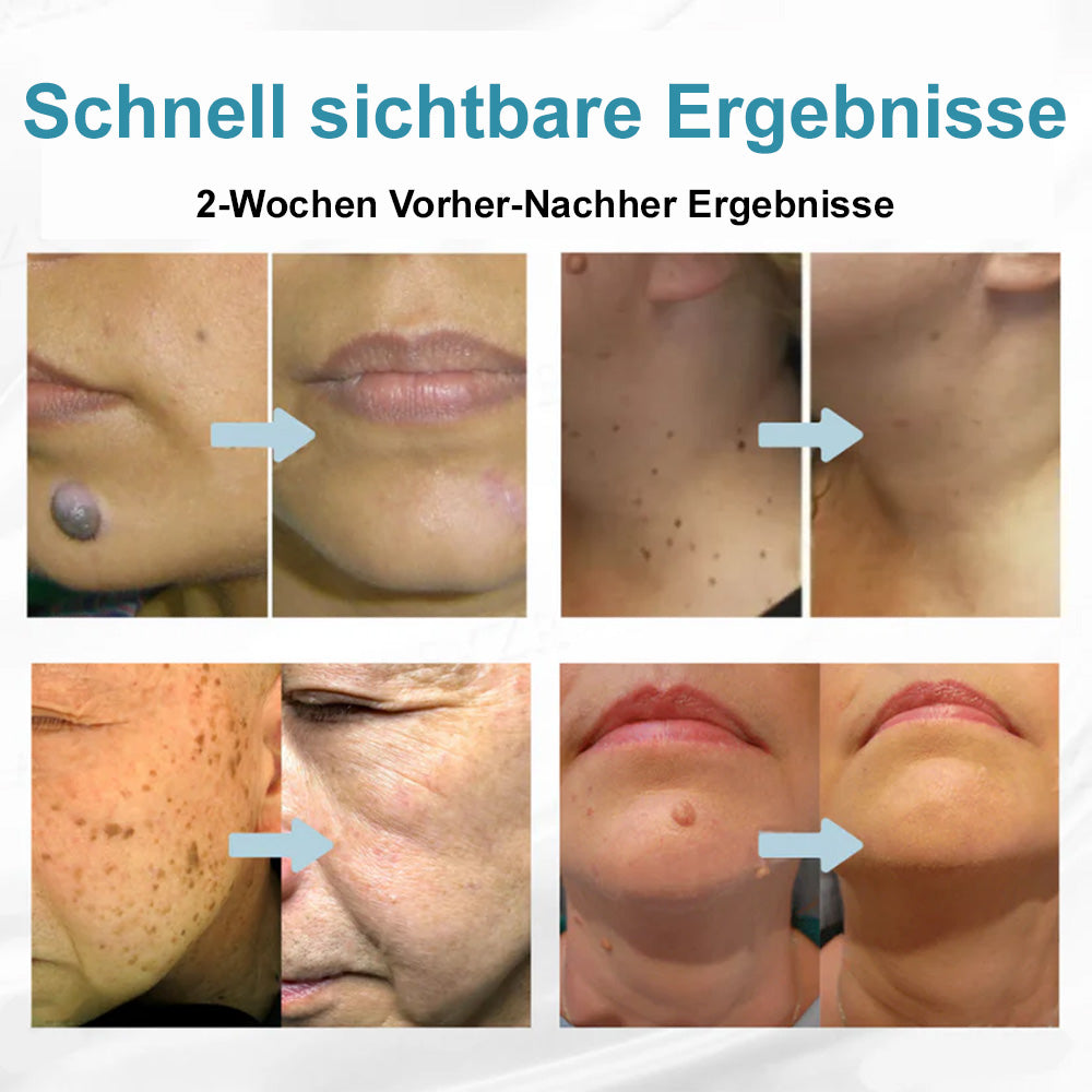 💙Bikenda® Nicht-invasiver Laser-Stift für Muttermale und Warzen – Schmerzfrei, narbenfrei, sicher | Dermatologisch geprüft