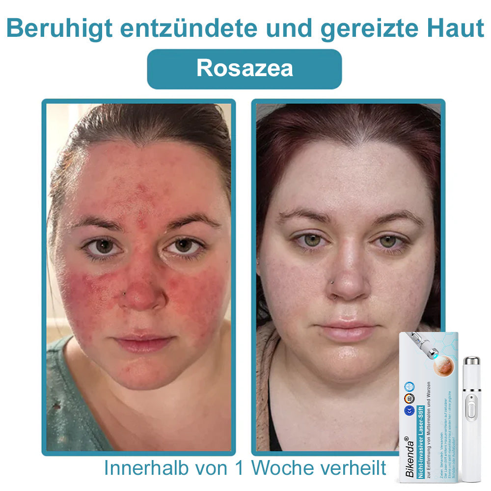 💙Bikenda® Nicht-invasiver Laser-Stift für Muttermale und Warzen – Schmerzfrei, narbenfrei, sicher | Dermatologisch geprüft