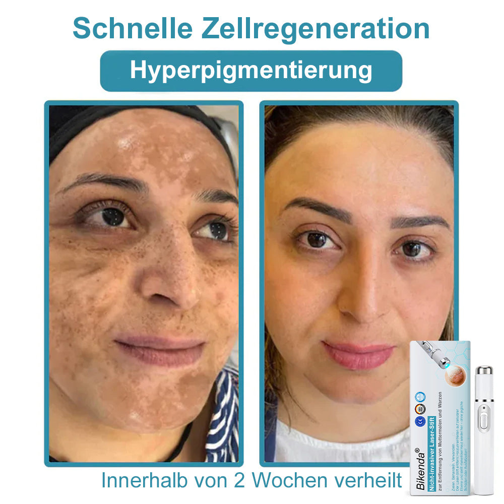 💙Bikenda® Nicht-invasiver Laser-Stift für Muttermale und Warzen – Schmerzfrei, narbenfrei, sicher | Dermatologisch geprüft