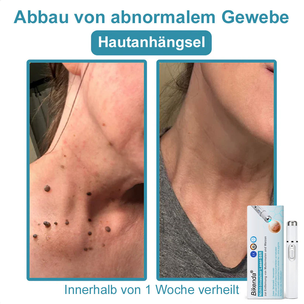 💙Bikenda® Nicht-invasiver Laser-Stift für Muttermale und Warzen – Schmerzfrei, narbenfrei, sicher | Dermatologisch geprüft