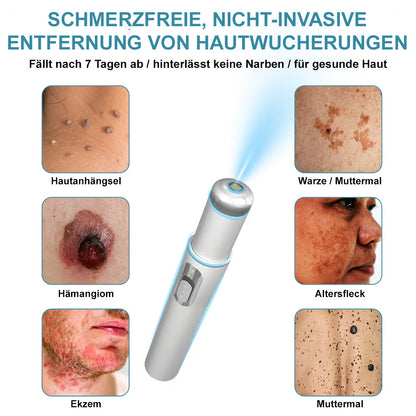 💙Bikenda® Nicht-invasiver Laser-Stift für Muttermale und Warzen – Schmerzfrei, narbenfrei, sicher | Dermatologisch geprüft
