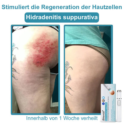 💙Bikenda® Nicht-invasiver Laser-Stift für Muttermale und Warzen – Schmerzfrei, narbenfrei, sicher | Dermatologisch geprüft